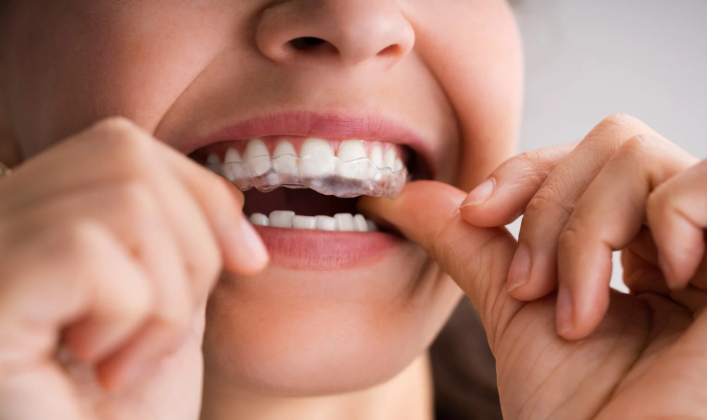 Clear aligners to straighten teeth discreetly in Leavenworth, KS at Family Dental Care