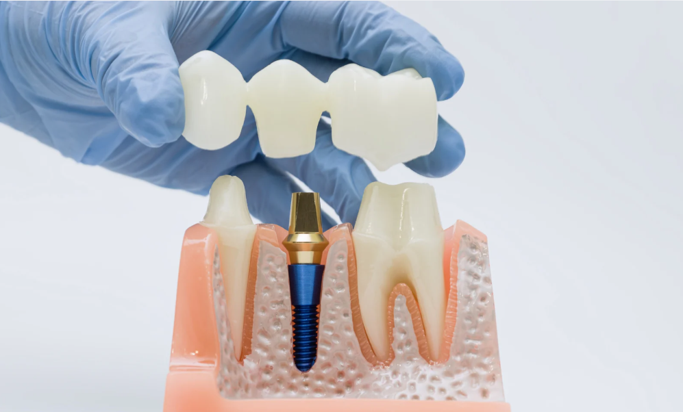 Dental crowns and bridges in Leavenworth, KS at Family Dental Care