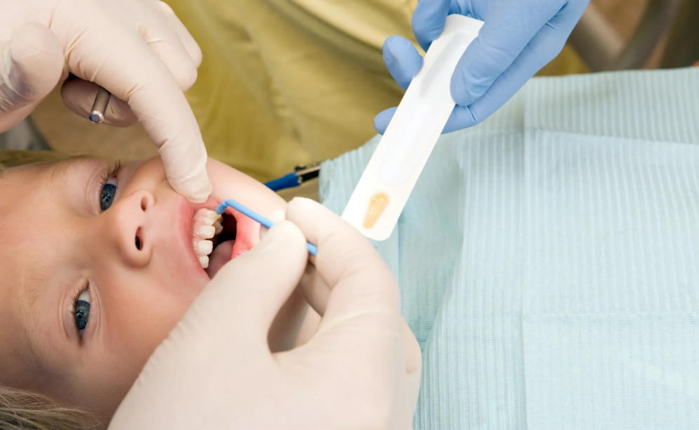 Fluoride treatment to strengthen enamel in Leavenworth, KS at Family Dental Care