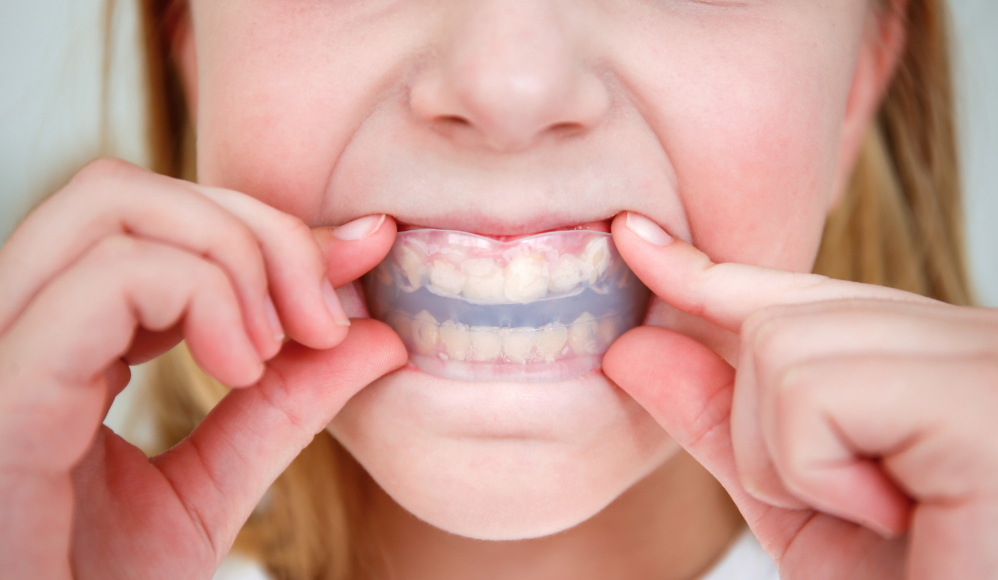 Custom night guard for teeth grinding at Family Dental Care in Leavenworth, KS