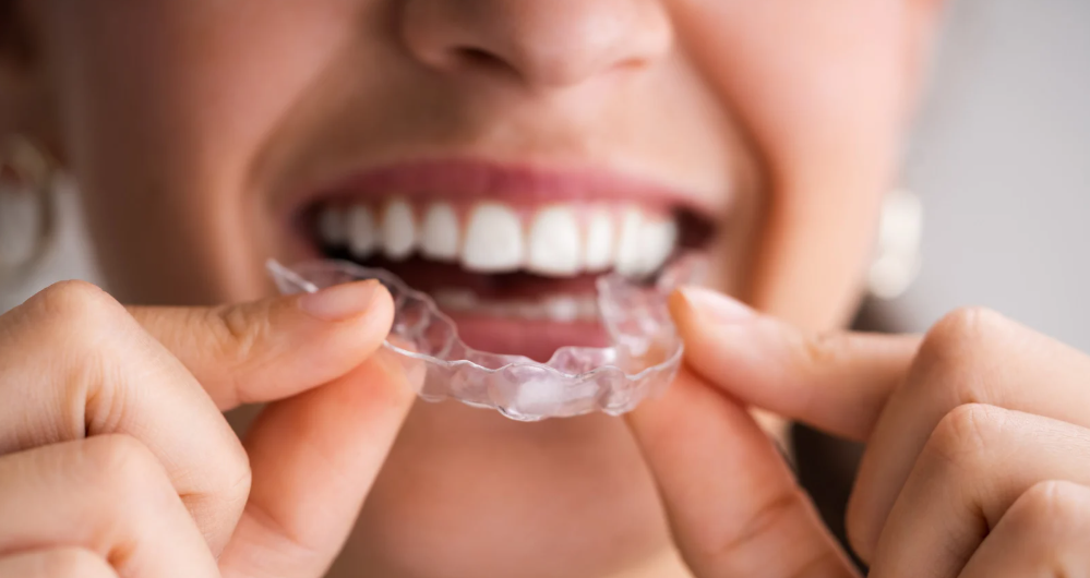 Custom mouthguards and night guards in Leavenworth, KS at Family Dental Care