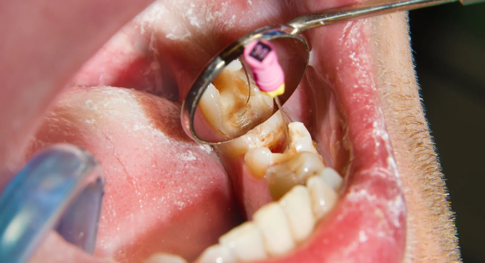 Root canal treatment to relieve tooth pain in Leavenworth, KS at Family Dental Care