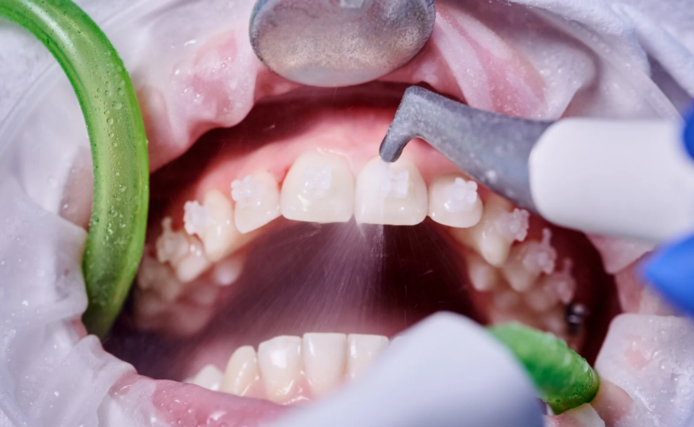 Dental hygiene and cleaning at Family Dental Care in Leavenworth, KS
