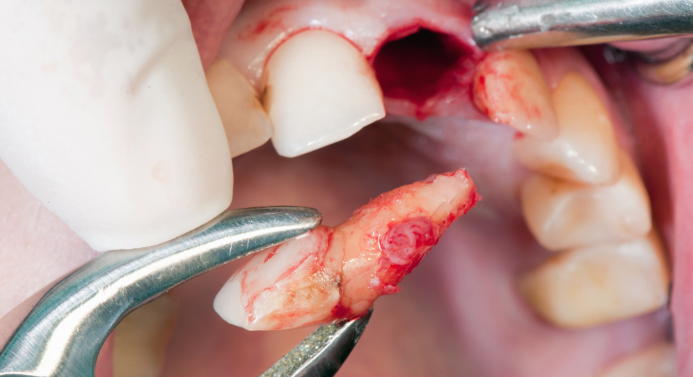 Gentle tooth extraction in Leavenworth, KS at Family Dental Care