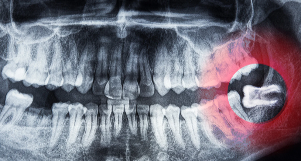 Wisdom teeth X-ray evaluation at Family Dental Care in Leavenworth, KS
